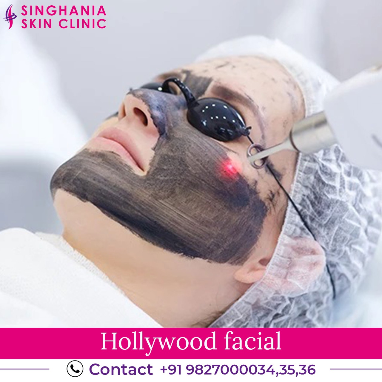 Hollywood Facial (Carbon Laser facial)