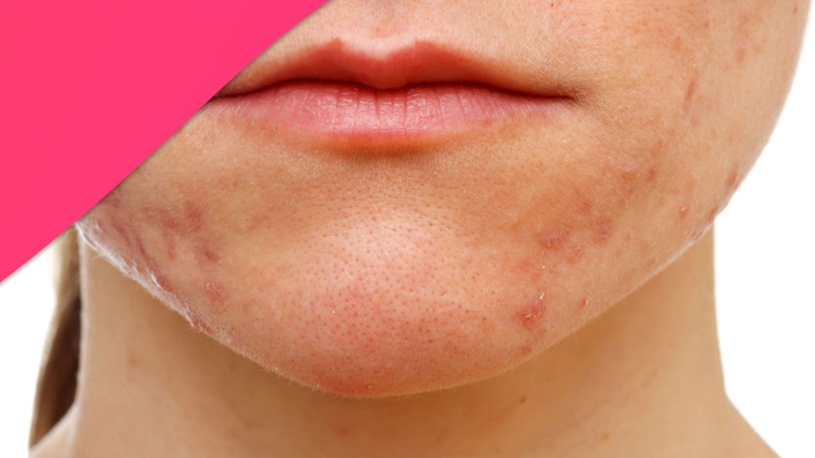 Causes of Acne Scars?