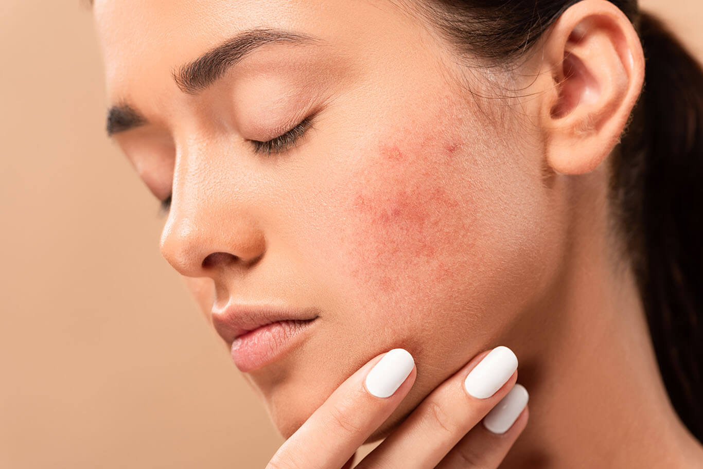 Acne Treatment Singhania Skin Clinic