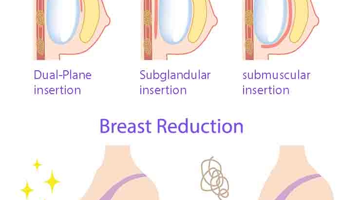 Breast Augmentation and Reduction