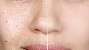 Enlarged Facial Pores