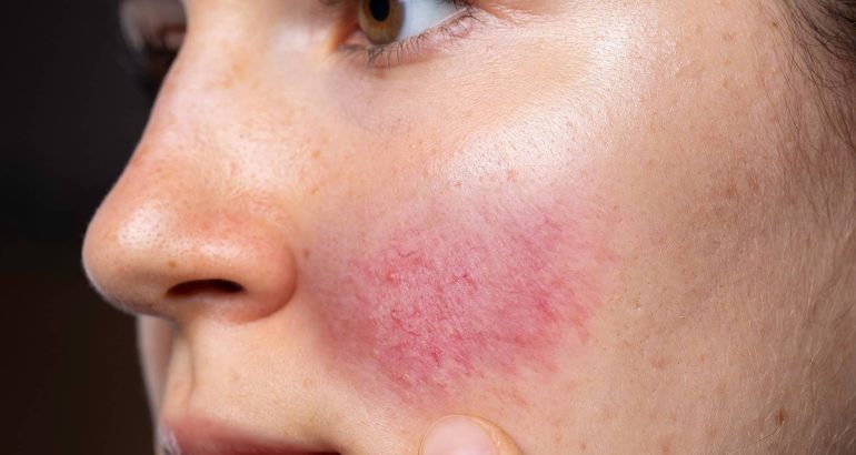 Rosacea