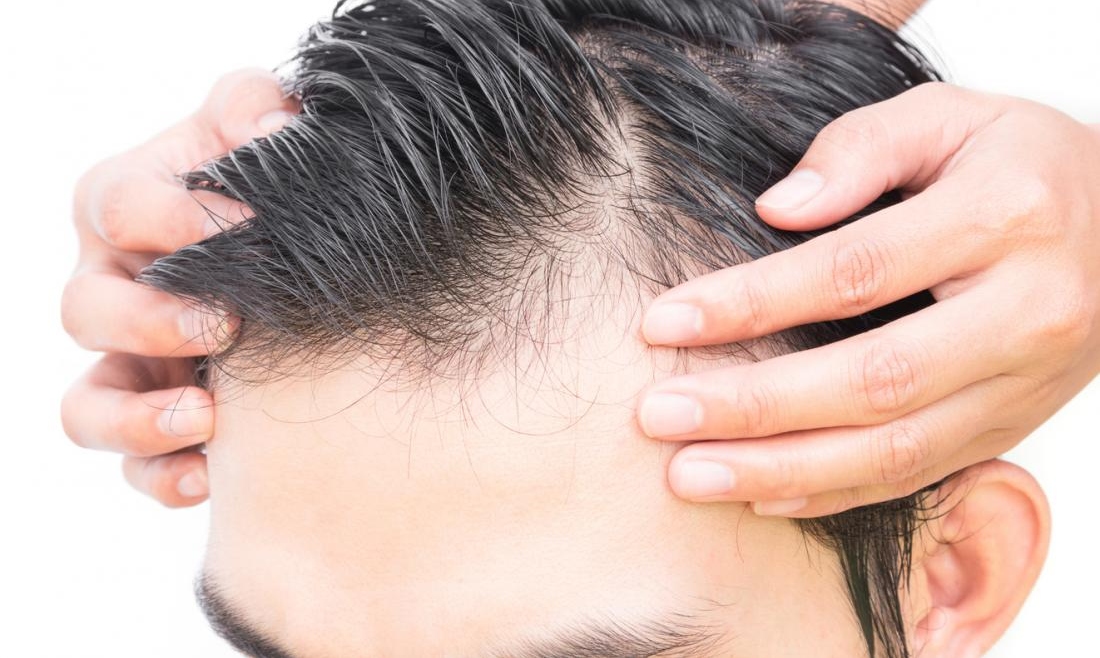 Hair fall in Men - Singhania Skin Clinic