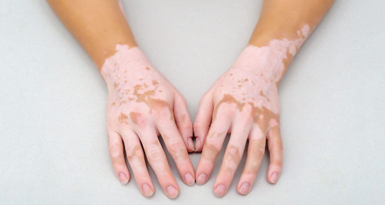 Vitiligo