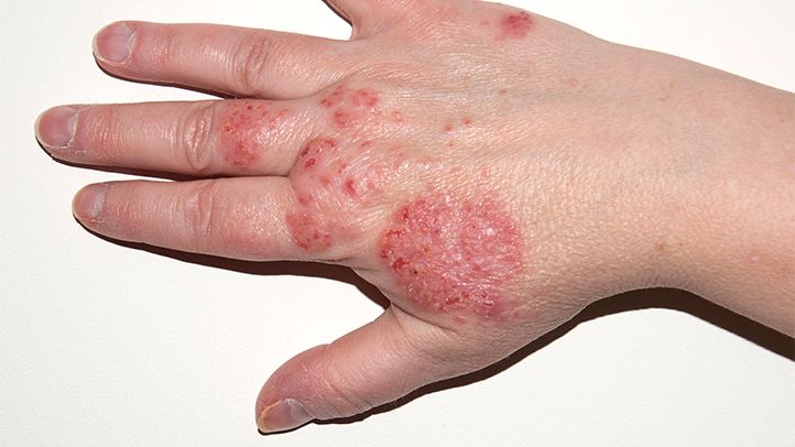 Paronychia (Nail Fold Infection) - Katu Dermatology Clinic