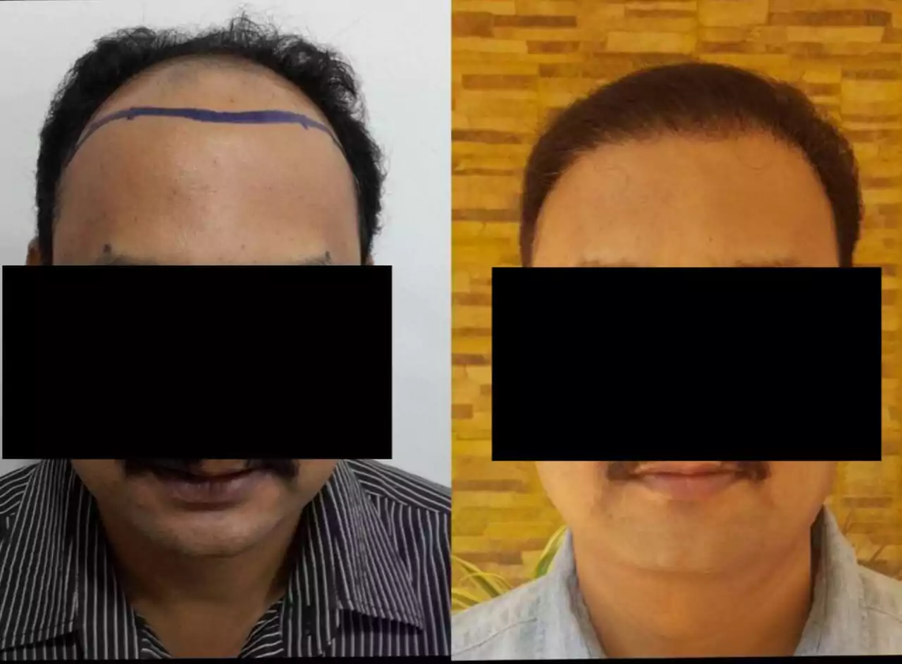 Hair Transplant Center